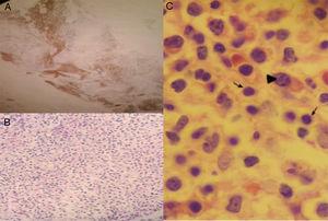 Biopsia de médula ósea. A) Tinción para CD20 positivo. B) Infiltración difusa por células pequeñas de aspecto linfoide y plasmocitos de aspecto maduro. Coloración H&E, ×40. C) Coloración H&E, ×100. Flechas: linfocitos, punta de flecha: plasmocito.