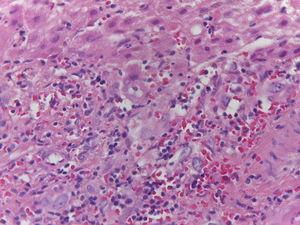 Biopsia de hígado con hematoxilina-eosina, con proliferación de linfocitos en los espacios porta, con daño a los conductos.