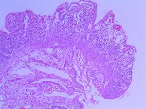 Biopsia de intestino con hematoxilina-eosina en la que se observa ulceración de la mucosa intestinal con aumento de la superficie usual de las criptas intestinales.