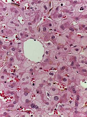 Biopsia de hígado con hematoxilina-eosina. Hepatocitos perivenulares con citoplasmas granulares, claros y depósito de hierro.