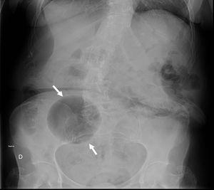 Radiografía simple de abdomen en la que se identifica una estructura redondeada y radiolúcida localizada en la FID (flechas).