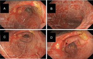 A-D) Imágenes de la panendoscopia oral mostrando una mucosa gástrica de cuerpo y antro pálida y nodular, con zonas de mucosa respetada y extensas y numerosas úlceras de tamaños variables (10-25mm) cubiertas de fibrina.