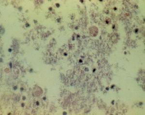 Trofozoitos de Entamoeba histolytica, en la pared del colon, identificados en el estudio histopatológico del paciente.
