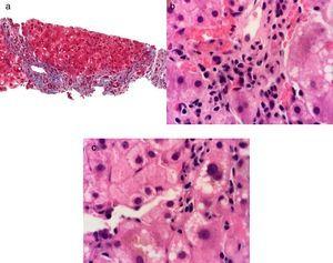 Tinción de Masson a 40X, se observa fibrosis grado III por presencia de algunos puentes de fibrosis del espacio porta-porta a). Tinción de hematoxilina-eosina a 100X, se observa hepatitis de interface por presencia de un infiltrado inflamatorio linfo plasmocitario que sobrepasa la placa limitante b) y hepatitis crónica lobulillar por presencia de un infiltrado inflamatorio linfoplasmocitario, vacuolación de hepatocitos y colestasis intracitoplásmica en el lobulillo hepático c).