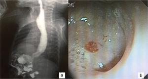 a) SEGD que muestra dilatación del cuerpo esofágico y un vestigio gástrico tubular; b) imagen endoscópica del aparente remanente gástrico.