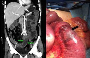 A)La tomografía computarizada de abdomen se muestra áreas segmentarias de hipoperfusión de la pared intestinal (flechas verdes). B)Imagen intraoperatoria con múltiples zonas isquémicas, circunferenciales, bien delimitadas, en el intestino delgado (flecha negra).
