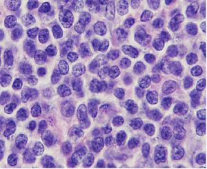 Citológicamente se observan células de pequeño tamaño, de núcleo hipercromático y hendido, con escaso citoplasma (hematoxilina y eosina, 400×).