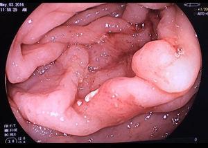 Endoscopia alta: pliegues engrosados con zonas de mucosa eritematosa y distensibilidad disminuida localizados en el cuerpo gástrico.