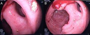 a y b) Colonoscopia: lesión polipoidea, ulcerada, localizada en el colon ascendente.