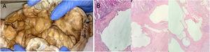 A) Fotografía de segmento intestinal de 22× 8cm de diámetro de colon sigmoides con múltiples lesiones de tipo quístico en pared colónica de contenido aéreo. B) Microfotografía que muestra el aspecto histológico de la pared intestinal. Espacios quísticos ubicados de manera predominante en la submucosa revestidas internamente por macrófagos, linfocitos, células plasmáticas, abundantes células multinucleadas y áreas de fibrosis (coloración hematoxilina & eosina).