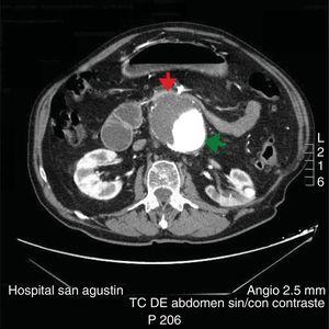 Compressão duodenal por aneurisma.