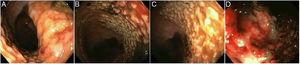 Lesión de recto, grande, de crecimiento lateral, nodular (A-C), con estigmas de hemorragia reciente (coágulos) (D).
