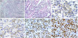 Tinción de las biopsias tomadas en endoscopia. A y B) Hematoxilina y eosina, donde se aprecian células neoplásicas mezcladas con linfocitos maduros, así como vasculitis de pequeños vasos. Las células neoplásicas son positivas para CD138 (C), CD79a (D), MUM1 (E) y Ki-67 (F).