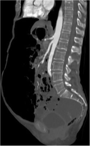 Tomografía abdominal con reconstrucción sagital donde se observa abundante neumoperitoneo, neumatosis intestinal y líquido libre en hueco pélvico.