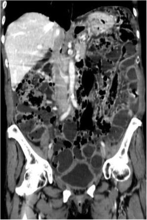 Tomografía abdominal con reconstrucción coronal donde se observa neumatosis intestinal de forma difusa con un patrón predominantemente quístico.
