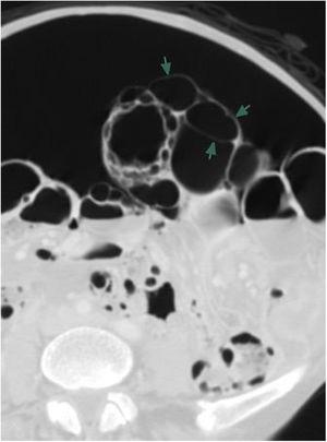 Tomografía abdominal en corte axial donde se observa abundante neumoperitoneo y neumatosis intestinal con un patrón quístico (flechas).