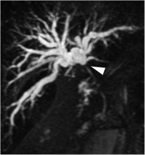 Reconstrucción de colangiopancreatografía por resonancia magnética coronal (CPRM) que demuestra oclusión del tracto biliar debido a estenosis hiliar (punta de flecha) y dilatación de árbol biliar intrahepático.