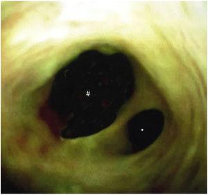 Colangioscopía del ducto biliar a nivel del hilio que muestra anatomía del área de confluencia del tracto biliar hepático derecho (#) e izquierdo (*) normal.