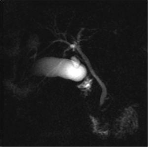 Reconstrucción de colangiopancreatografía por resonancia magnética coronal (CPRM) que muestra un árbol biliar normal.