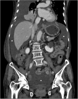 Corte coronal de tomografía de abdomen y pelvis. Se observa derrame pleural (flecha), derrame pericárdico (flecha vacía), ascitis (asteriscos [*]) y edema de tejidos blandos.