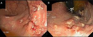 Colonoscopia: lesión ulcerada rectal de bordes irregulares. A) Úlcera rectal en visión frontal. B) Úlcera rectal en retrovisión.