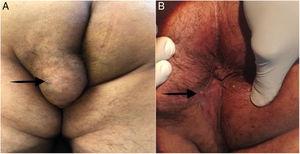 A) Tumor bien definido de 6×6cm en el glúteo izquierdo y el perineo. La flecha negra apunta hacia el orificio externo de la fístula perianal. B) La herida perianal fue sanada por intención secundaria en el seguimiento a 12 meses. La flecha negra apunta hacia la cicatriz del orificio externo de la fístula completamente sanada.