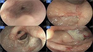 A) Úlceras lineales, erosiones aftoides y muescas de Kerckring en esófago. B) Severos cambios inflamatorios que afectan la mucosa del cuerpo, con evidencia de eritema, edema, nodularidad, con úlceras profundas y segmentarias. C) Visión del antro gástrico, evidencia de úlcera profunda que afecta más del 70% de la circunferencia, con áreas en sacabocados, deformidad pilórica y puente mucoso (flecha negra). D) Severos cambios inflamatorios en duodeno, con evidencia de úlceras serpiginosas y una úlcera dominante en DII recubierta de fibrina.