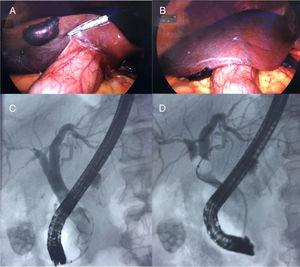 A y B. Visión laparoscópica del hematoma subcapsular como hallazgo transquirúrgico. C y D. Imagen de colangiografía mediante la CPRE.