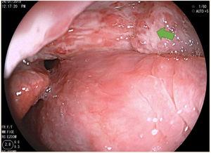 Lesión granulomatosa en receso gloso epiglótico derecho (flecha verde).