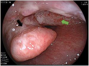 Lesión granulomatosa en receso gloso epiglótico derecho (flecha verde) que se extiende hacia epiglotis (flecha negra).