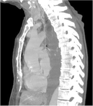 Tomografía axial de tórax donde se observa engrosamiento concéntrico del tercio superior y medio del esófago asociándose a vaso anómalo dilatado en la pared muscular del tercio medio del esófago en fase arterial.