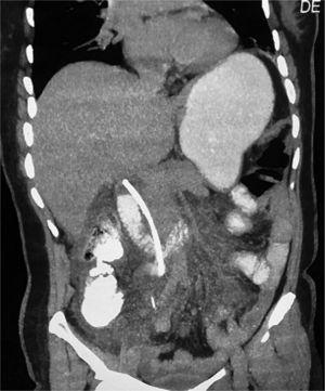 Imagen de tomografía computarizada de abdomen, con contraste oral. Se aprecia la endoprótesis migrada, perforación en tercera porción de duodeno, y fuga de medio de contraste.