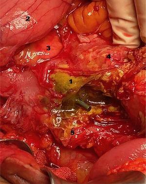 Imagen del procedimiento quirúrgico. Número 1: tercera porción de duodeno perforada por prótesis, 2: estómago; 3: cabeza de páncreas; 4: mesocolon; 5: retroperitoneo.