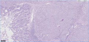 Imagen con 5 aumentos de muestra yeyunal. En la parte izquierda se aprecia el epitelio intestinal normal. En la parte centro-derecha observamos una submucosa con infiltración de células atípicas pigmentadas Tinción: hematoxilina-eosina.