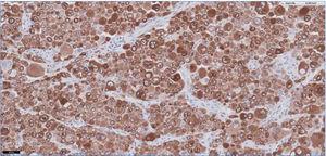 Imagen con 20 aumentos de muestra yeyunal. Observamos los melanocitos infiltrando de forma difusa el tejido (color marrón) Tinción: MelanA.