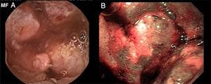 Adenocarcinoma intestinal ulcerado moderadamente diferenciado; A. VCE B. Enteroscopia de doble balón anterógrada.