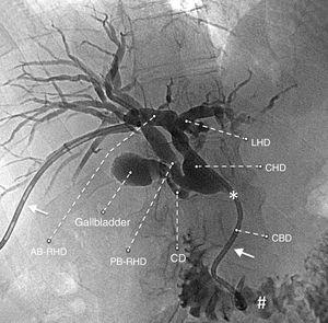 Colangiografía con conductos biliares dilatados y una variante anatómica: rama anterior del conducto hepático derecho (AB-RHD), rama posterior del conducto hepático derecho (PB-RHD), conducto cístico (CD), conducto hepático izquierdo (LHD), conducto hepático común (CHD), conducto biliar común (CBD).