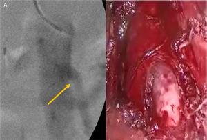 A) Arteriografía donde se demuestra el tronco celíaco con angulación superior; B) Vista laparoscópica de compresión extrínseca del tronco celíaco por ligamento arcuato medio.
