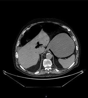 Corte axial de TC abdominal con contraste iv: se visualiza abundante gas en vena porta (neumatosis portal).