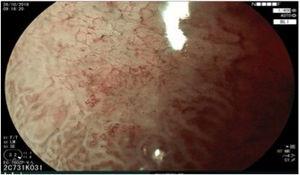 Magnificación de imagen máxima y cromoendoscopia virtual BLI (Blue Laser Imaging, Fujifilm Co., Japón) de la parte deprimida de la lesión evidenciando la microsuperfície irregular y microvasos dilatados y tortuosos.