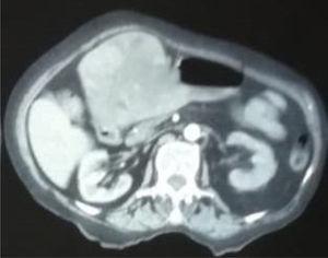 TAC abdominal contrastada donde se aprecia el tumor hepático invadiendo la cámara gástrica, la lesión es heterogénea y se encuentra en el segmento IV del hígado.