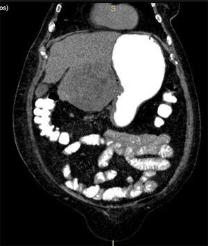 TAC abdominal en un corte coronal, en donde se muestra la tumoración hepática invadiendo el estómago.