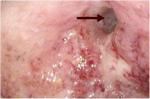 Estenosis de colon en colonoscopía, con mucosa ulcerada, sangrado espontáneo y pérdida de patrones vasculares y haustrales. Se identifica una estenosis que inhibe el paso del colonoscopio (flecha).