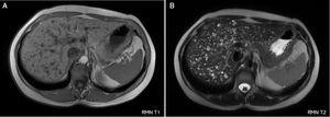 Resonancia magnética abdominal: Numerosas lesiones redondeadas hipointensas en T1 (a) e hiperintensas en T2 (b).