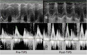 Derivación portosistémica trasyugular intrahepática (TIPS) (A y C) y medidas de ecocardiograma post-TIPS (B, D). A) TAPSE pre-TIPS de 18.8mm B) TAPSE post-TIPS TAPSE de 14.4mm C) Relación de onda E/A pre-TIPS E/A de 1.2. D) Relación de onda E/A post-TIPS de 1.54. TAPSE: excursión sistólica de plano anular tricúspide.