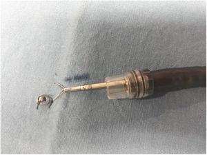 Anclaje magnético, se observa el imán interno de neodimio sujeto a una rama de clip mediante sutura seda 2-0.