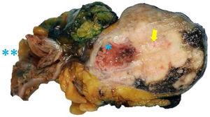 Lesión «dumbbell» con crecimiento extraluminal (flecha) e intraluminal estenosando parcialmente la luz intestinal (*) y que confiere al tumor un aspecto de «mancuerna» o pesa. La pieza muestra también la sección de la luz intestinal normal (**).