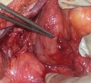 Perforación duodenal parcialmente cerrada con el sistema OVESCO con la pinza endoscópica atrapada.