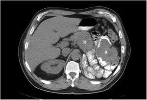 Imagen de corte axial de la TC abdominal empleando contraste oral que muestra fosa renal izquierda ocupada por asas de intestino delgado (a), además de una lesión hiperdensa, con infiltración a asas intestinales y pared gástrica (b).