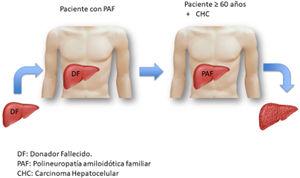 El hígado de un paciente de donador fallecido es trasplantado en un paciente con polineuropatía amiloidótica familiar (PAF). El hígado del paciente con PAF es a su vez trasplantado en un paciente cercano a los 60 años y con una urgencia relativa de trasplante.